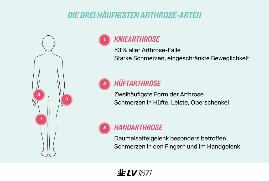 infografik-drei-haeufigsten-arthrose-arten Infografik mit den drei häufigsten Arten von Arthrose: Kniearthrose, Hüftarthrose, Handarthrose